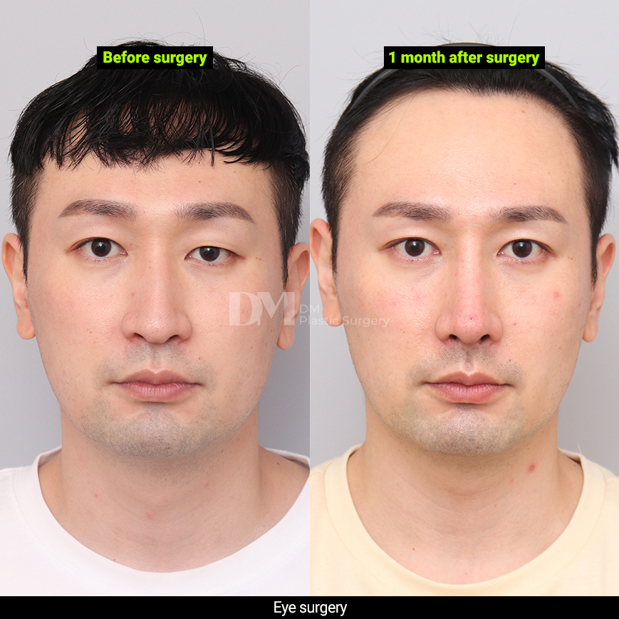 /images/en/Eyes_EyesSurgery/plastic surgery in korea_eyes surgeryBA05.jpg